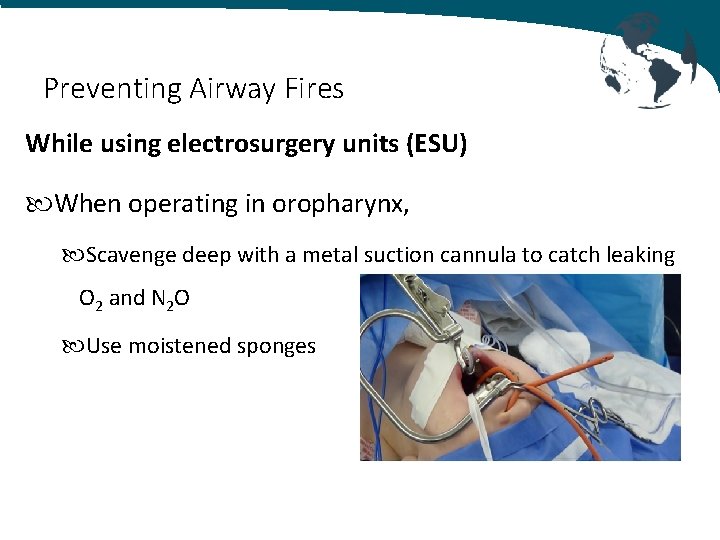 Preventing Airway Fires While using electrosurgery units (ESU) When operating in oropharynx, Scavenge deep