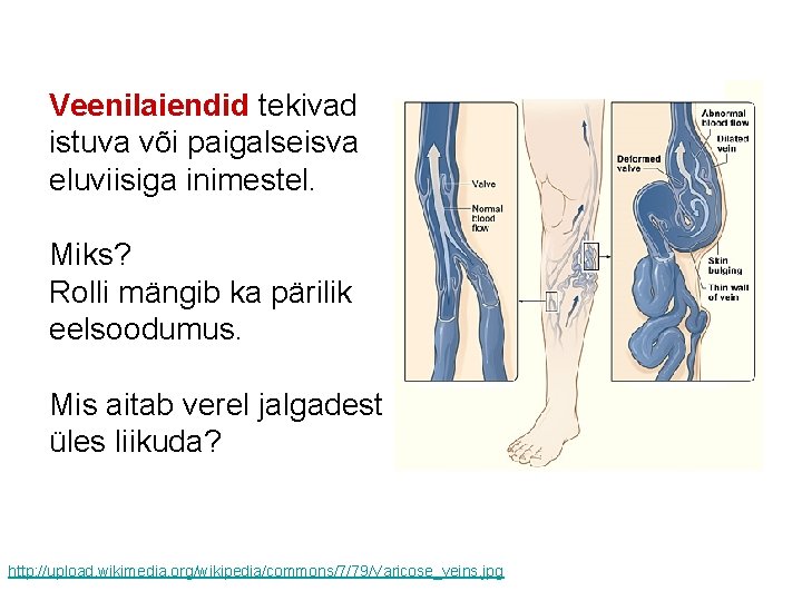 Veenilaiendid tekivad istuva või paigalseisva eluviisiga inimestel. Miks? Rolli mängib ka pärilik eelsoodumus. Mis