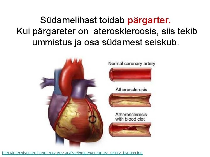 Südamelihast toidab pärgarter. Kui pärgareter on ateroskleroosis, siis tekib ummistus ja osa südamest seiskub.