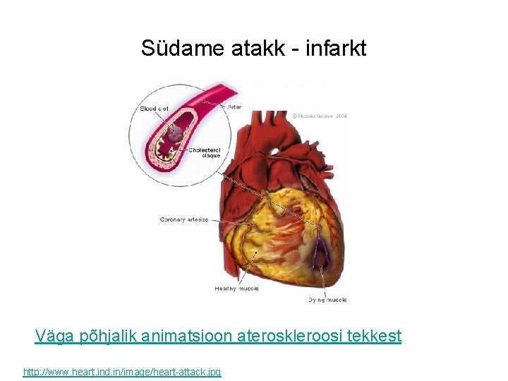 Südame atakk - infarkt Väga põhjalik animatsioon ateroskleroosi tekkest http: //www. heart. ind. in/image/heart-attack.