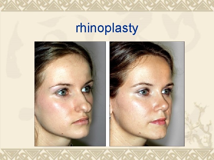 rhinoplasty 