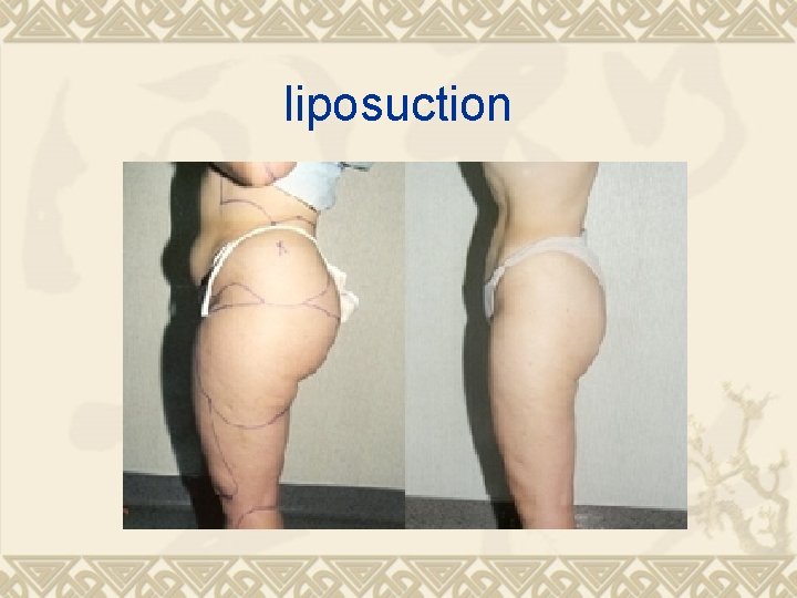 liposuction 