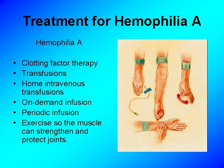 Treatment for Hemophilia A • Clotting factor therapy • Transfusions • Home intravenous transfusions