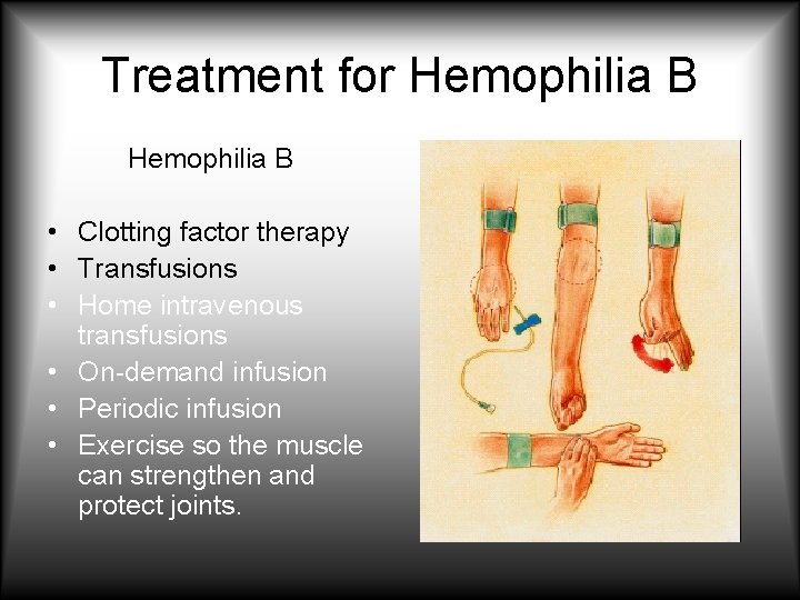 Treatment for Hemophilia B • Clotting factor therapy • Transfusions • Home intravenous transfusions