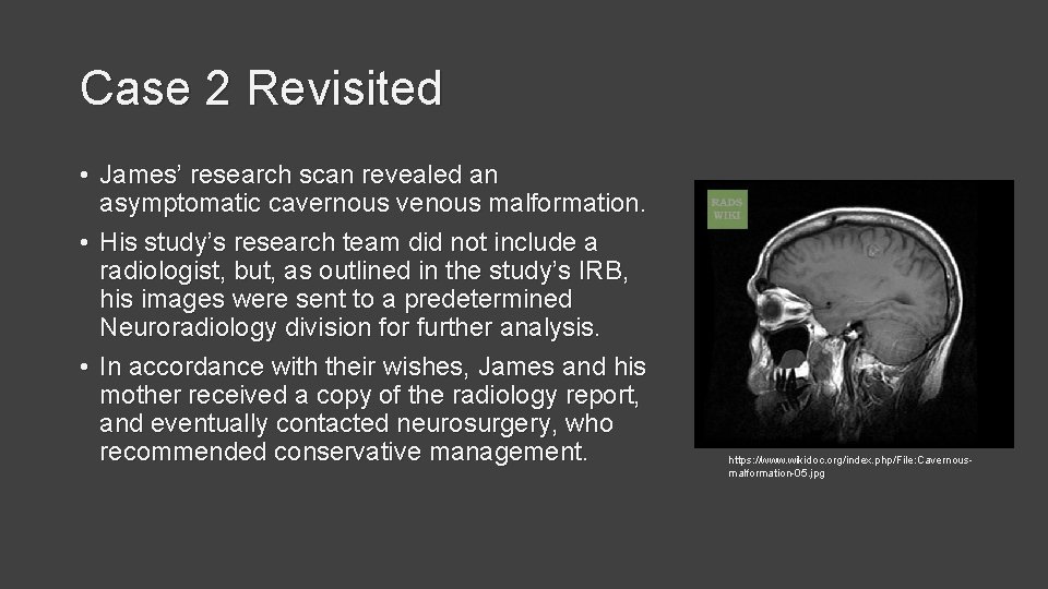 Case 2 Revisited • James’ research scan revealed an asymptomatic cavernous venous malformation. •