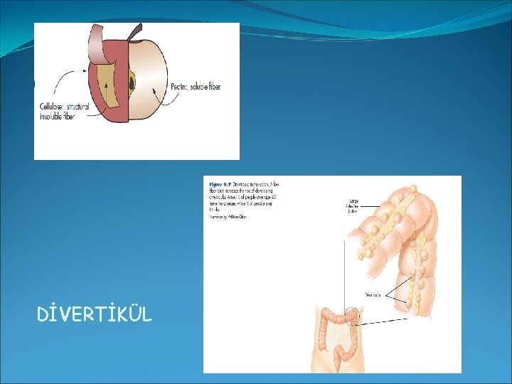 DİVERTİKÜL 