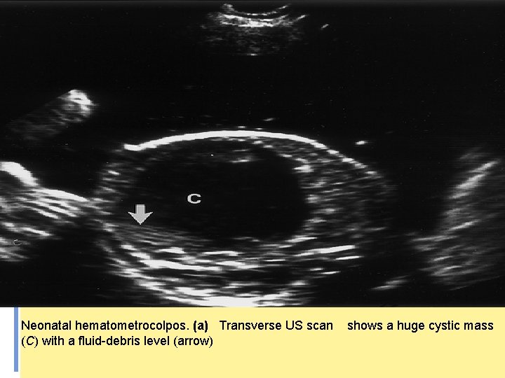 Neonatal hematometrocolpos. (a) Transverse US scan (C) with a fluid-debris level (arrow) shows a Neonatal hematometrocolpos. (a) Transverse US scan (C) with a fluid-debris level (arrow) shows a
