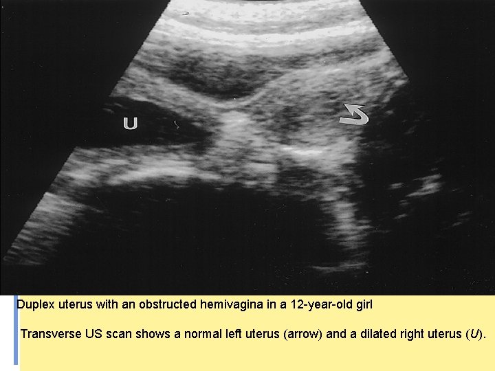 Duplex uterus with an obstructed hemivagina in a 12 -year-old girl Transverse US scan