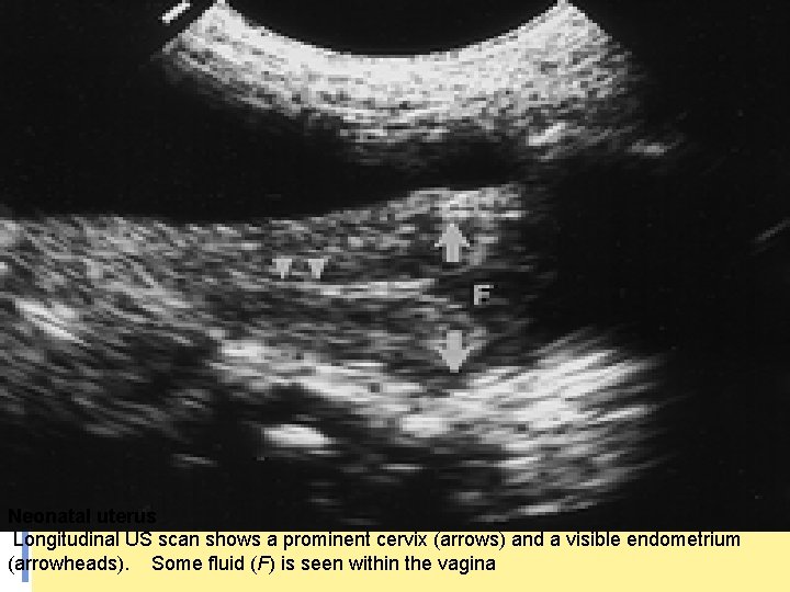 Neonatal uterus Longitudinal US scan shows a prominent cervix (arrows) and a visible endometrium