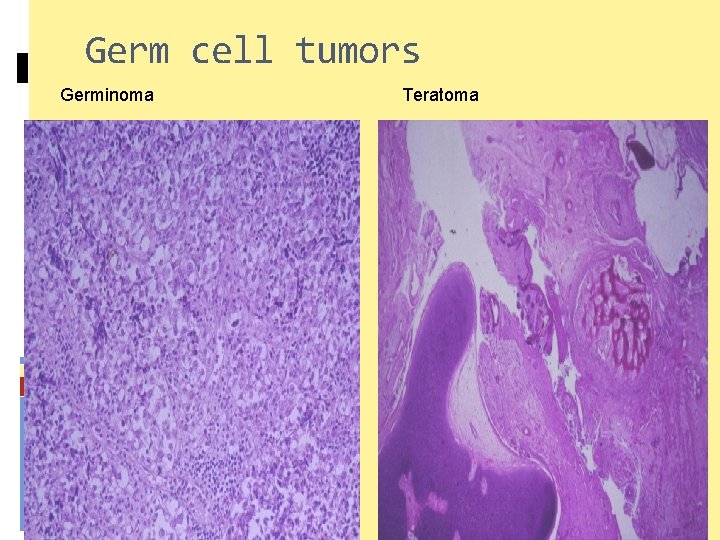 Germ cell tumors Germinoma Teratoma 