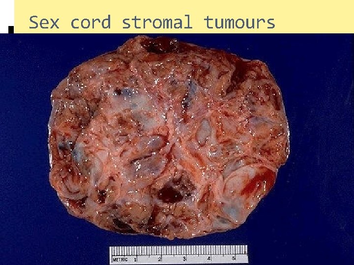 Sex cord stromal tumours 
