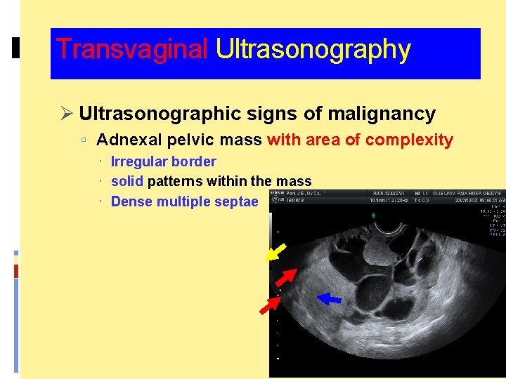Transvaginal Ultrasonography Ø Ultrasonographic signs of malignancy Adnexal pelvic mass with area of complexity