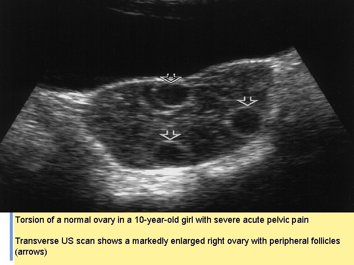 Torsion of a normal ovary in a 10 -year-old girl with severe acute pelvic
