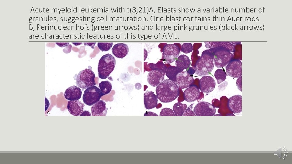 Acute myeloid leukemia with t(8; 21)A, Blasts show a variable number of granules, suggesting
