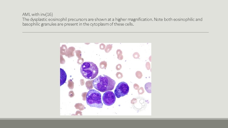 AML with inv(16) The dysplastic eosinophil precursors are shown at a higher magnification. Note