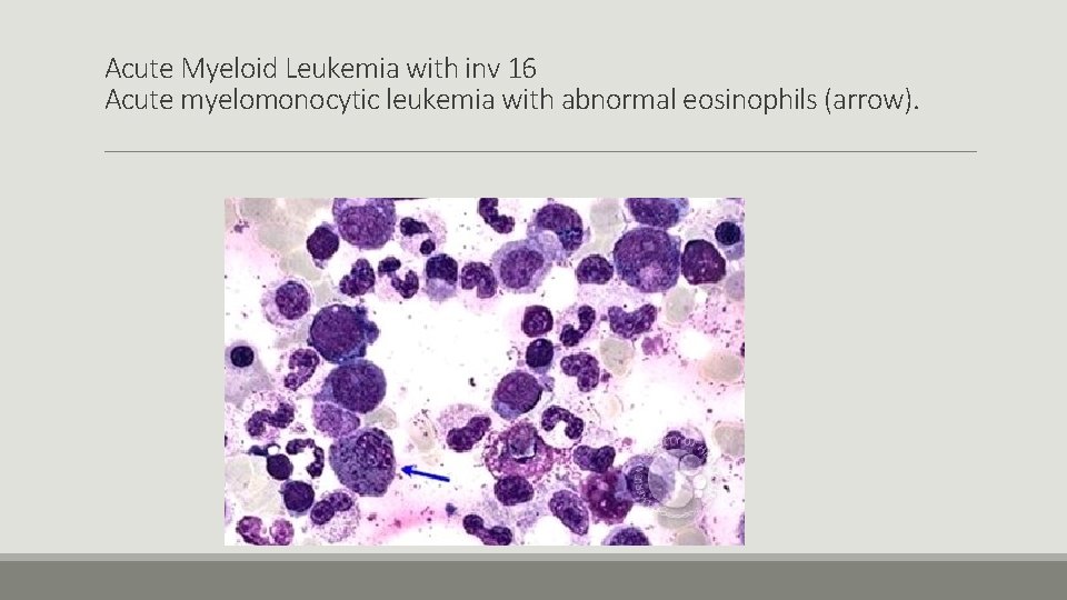 Acute Myeloid Leukemia with inv 16 Acute myelomonocytic leukemia with abnormal eosinophils (arrow). 