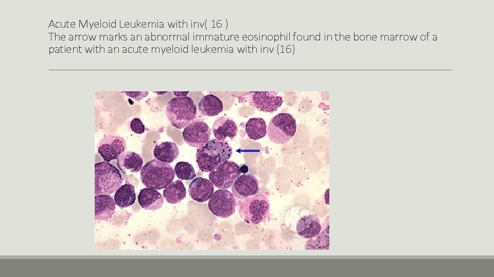 Acute Myeloid Leukemia with inv( 16 ) The arrow marks an abnormal immature eosinophil