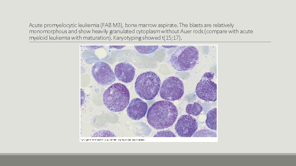 Acute promyelocytic leukemia (FAB M 3), bone marrow aspirate. The blasts are relatively monomorphous