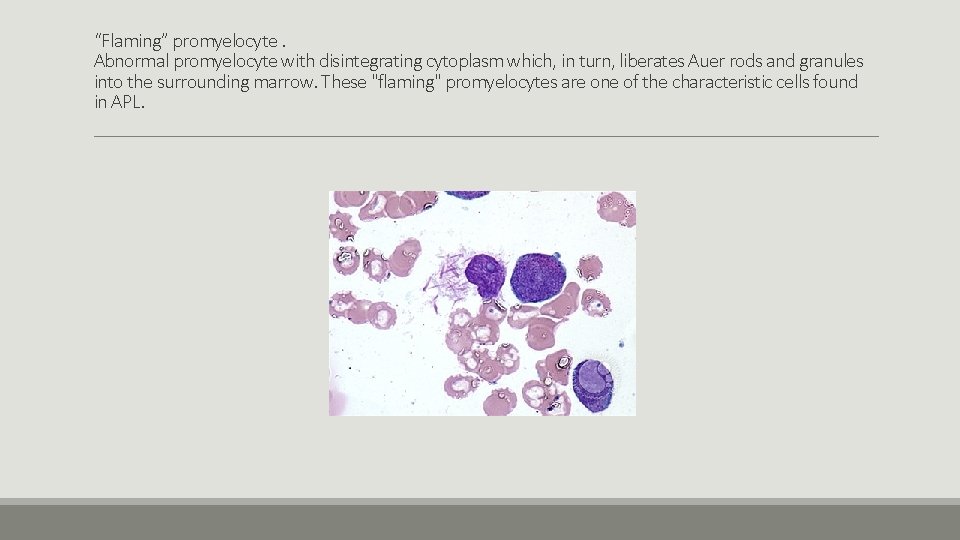 “Flaming” promyelocyte. Abnormal promyelocyte with disintegrating cytoplasm which, in turn, liberates Auer rods and