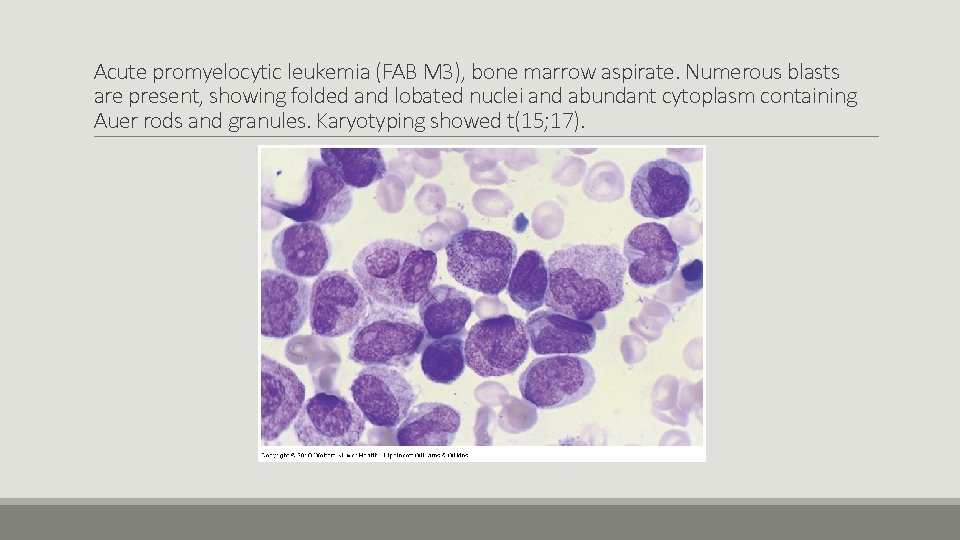 Acute promyelocytic leukemia (FAB M 3), bone marrow aspirate. Numerous blasts are present, showing