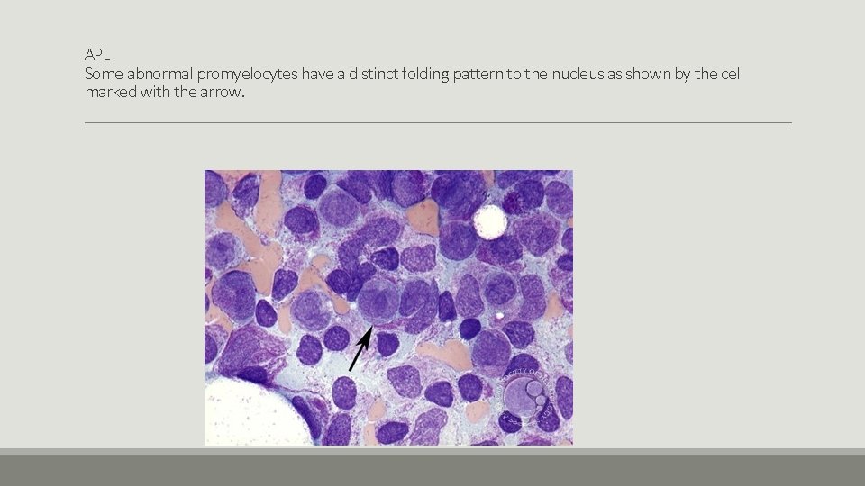 APL Some abnormal promyelocytes have a distinct folding pattern to the nucleus as shown