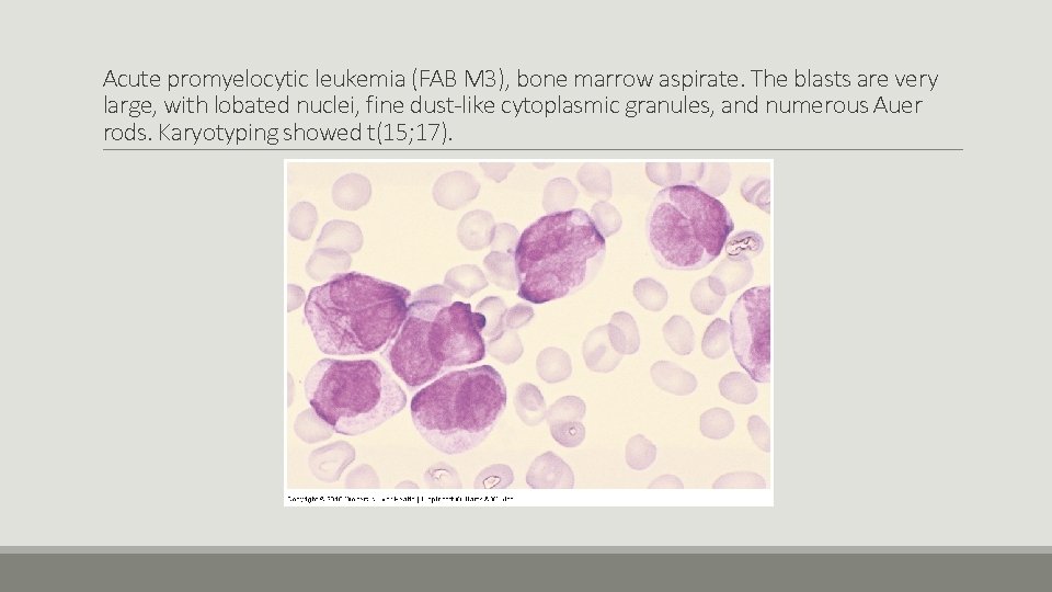 Acute promyelocytic leukemia (FAB M 3), bone marrow aspirate. The blasts are very large,