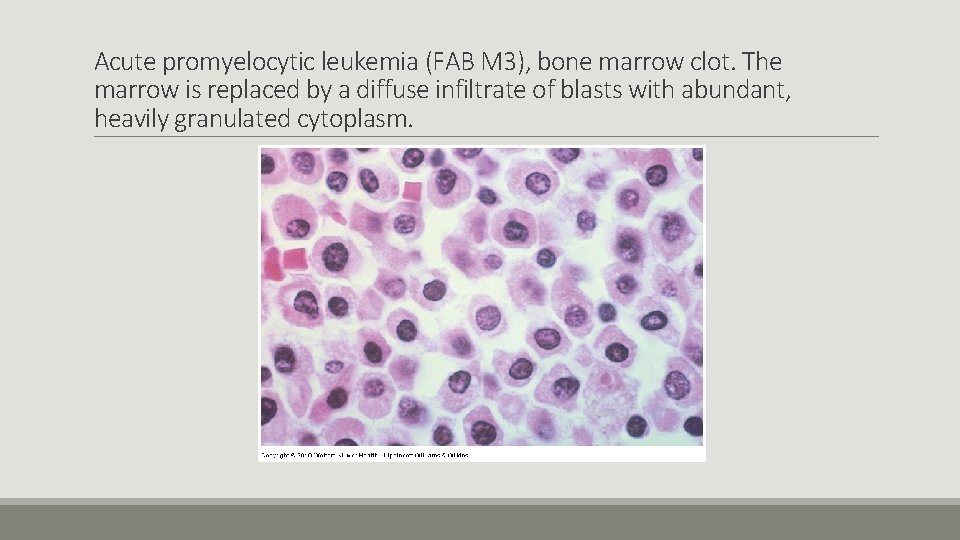 Acute promyelocytic leukemia (FAB M 3), bone marrow clot. The marrow is replaced by