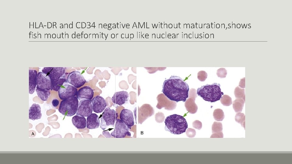 HLA-DR and CD 34 negative AML without maturation, shows fish mouth deformity or cup