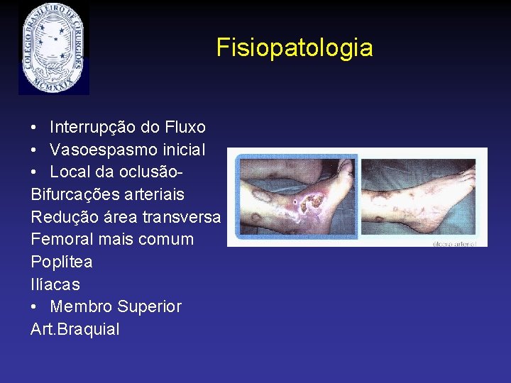 Fisiopatologia • Interrupção do Fluxo • Vasoespasmo inicial • Local da oclusão. Bifurcações arteriais