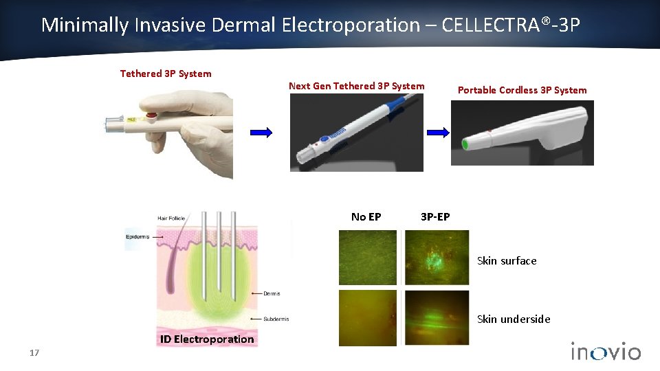 Minimally Invasive Dermal Electroporation – CELLECTRA®-3 P Tethered 3 P System Next Gen Tethered