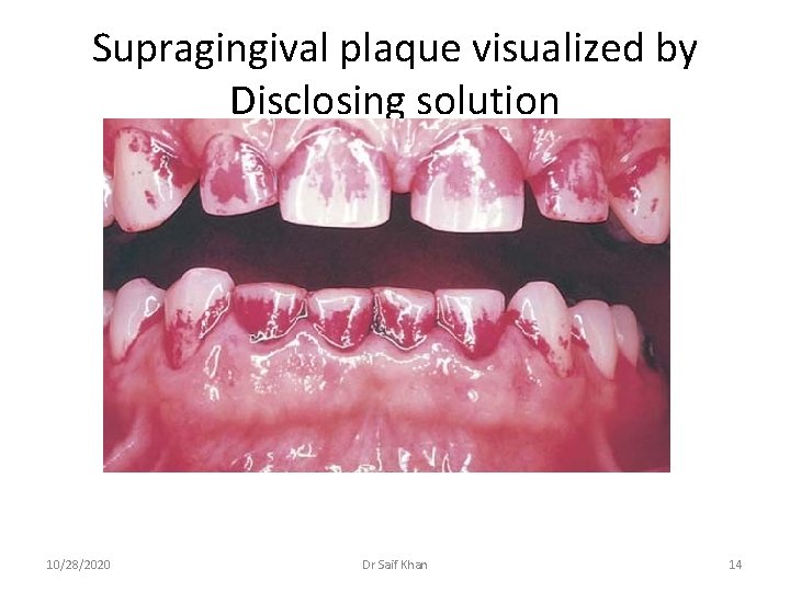 Supragingival plaque visualized by Disclosing solution 10/28/2020 Dr Saif Khan 14 