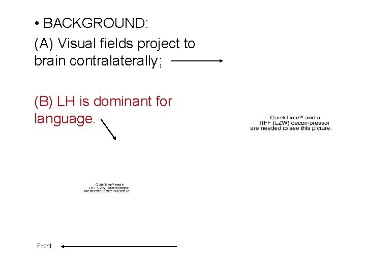  • BACKGROUND: (A) Visual fields project to brain contralaterally; (B) LH is dominant
