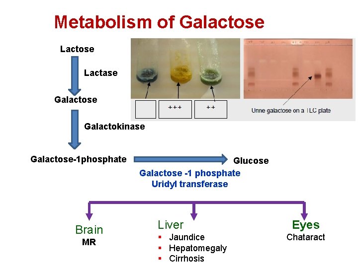 Metabolism of Galactose Lactase Galactokinase Galactose-1 phosphate Brain MR Glucose Galactose -1 phosphate Uridyl