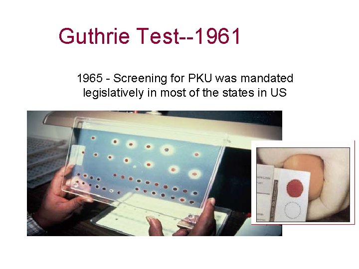 Guthrie Test--1961 1965 - Screening for PKU was mandated legislatively in most of the