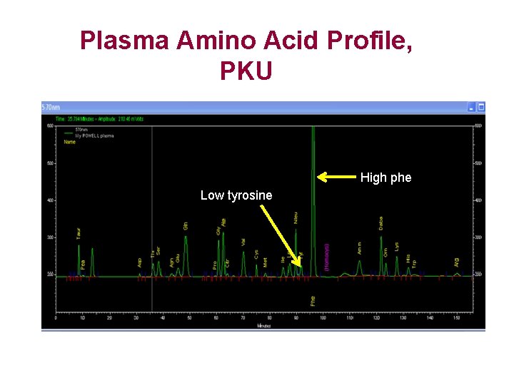 Plasma Amino Acid Profile, PKU Low tyrosine High phe Low tyrosine 