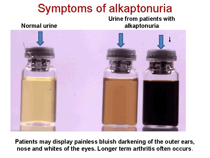 Symptoms of alkaptonuria Normal urine Urine from patients with alkaptonuria Patients may display painless