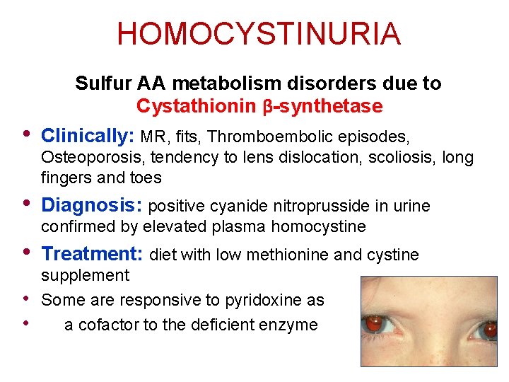 HOMOCYSTINURIA • Sulfur AA metabolism disorders due to Cystathionin β-synthetase Clinically: MR, fits, Thromboembolic