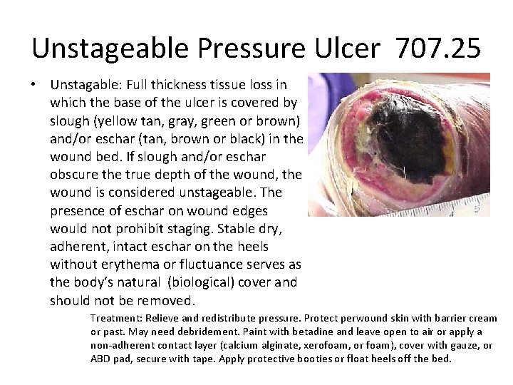 Unstageable Pressure Ulcer 707. 25 • Unstagable: Full thickness tissue loss in which the