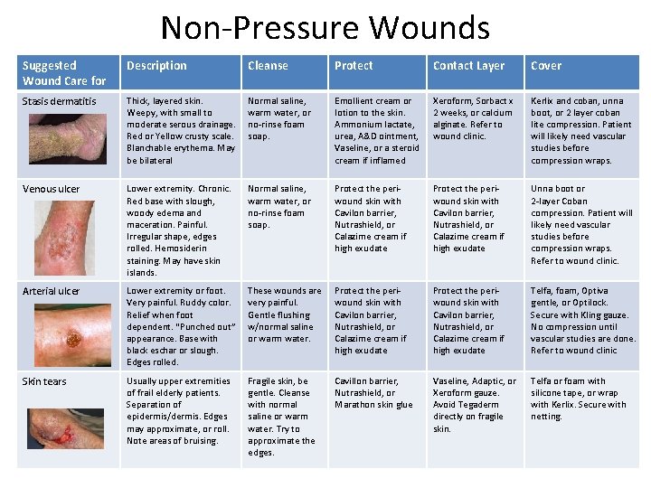 Non-Pressure Wounds Suggested Wound Care for Description Cleanse Protect Contact Layer Cover Stasis dermatitis