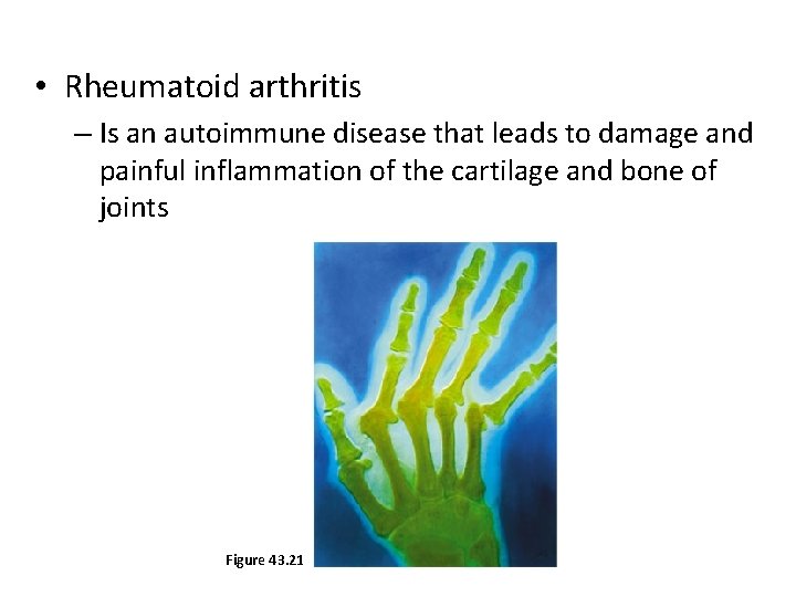  • Rheumatoid arthritis – Is an autoimmune disease that leads to damage and