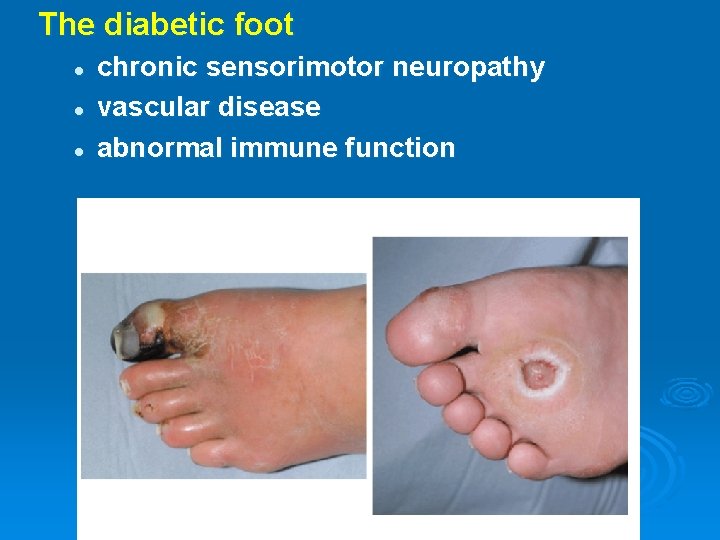 The diabetic foot l l l chronic sensorimotor neuropathy vascular disease abnormal immune function