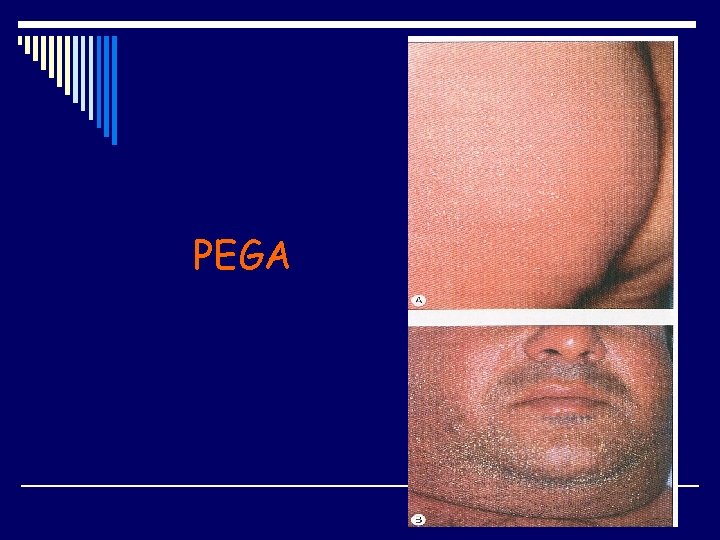 PEGA 