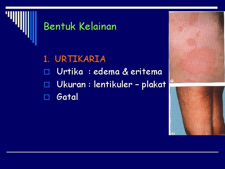 Bentuk Kelainan 1. URTIKARIA o Urtika : edema & eritema o Ukuran : lentikuler