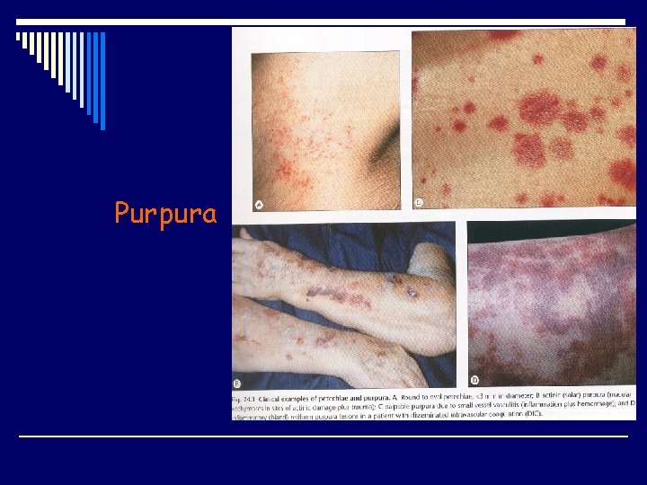 Purpura 