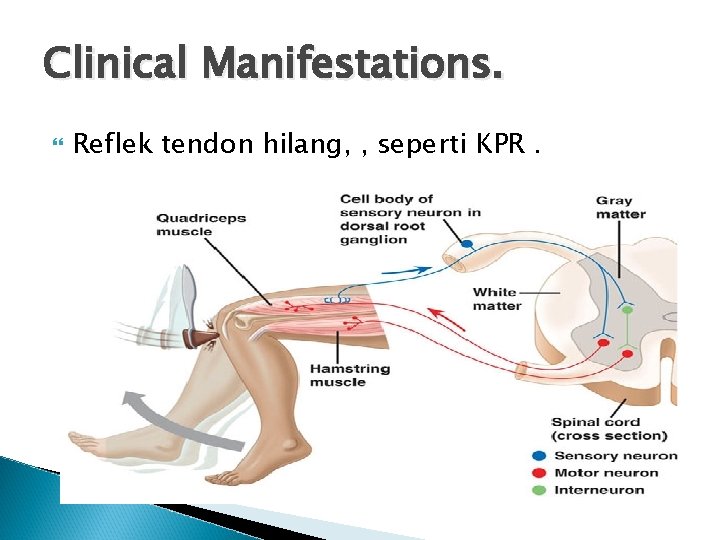 Clinical Manifestations. Reflek tendon hilang, , seperti KPR. 