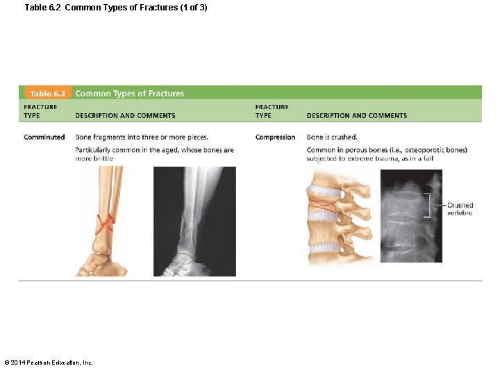 Table 6. 2 Common Types of Fractures (1 of 3) © 2014 Pearson Education,