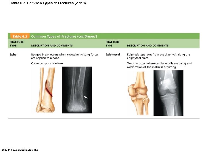 Table 6. 2 Common Types of Fractures (2 of 3) © 2014 Pearson Education,