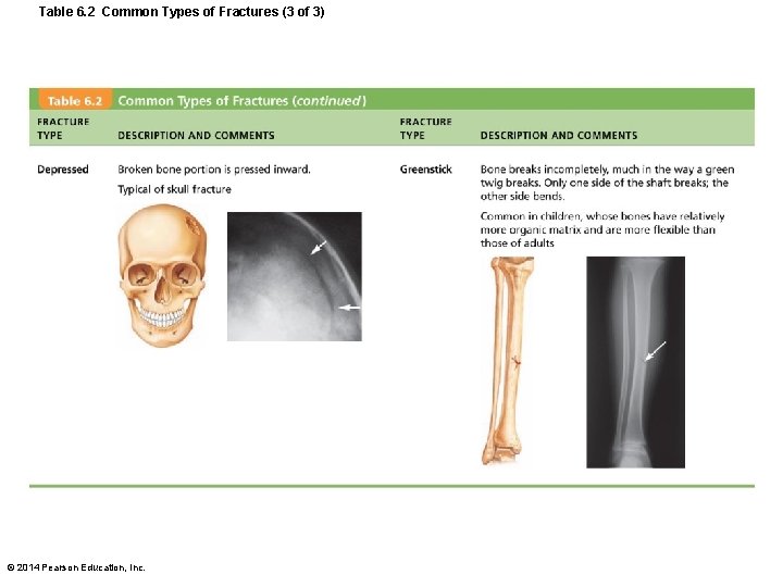 Table 6. 2 Common Types of Fractures (3 of 3) © 2014 Pearson Education,