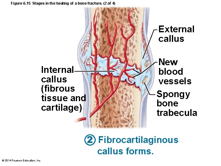 Figure 6. 15 Stages in the healing of a bone fracture. (2 of 4)