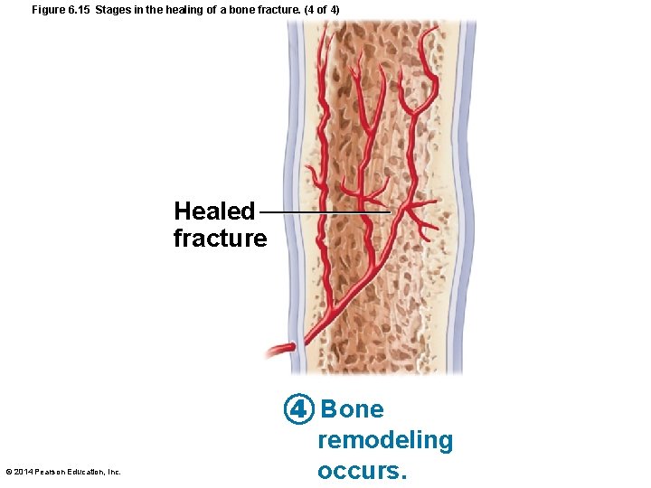 Figure 6. 15 Stages in the healing of a bone fracture. (4 of 4)